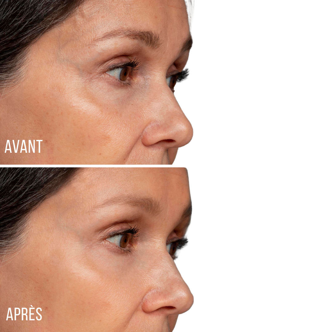 Appareil Anti Rides EMS RF Luminothérapie